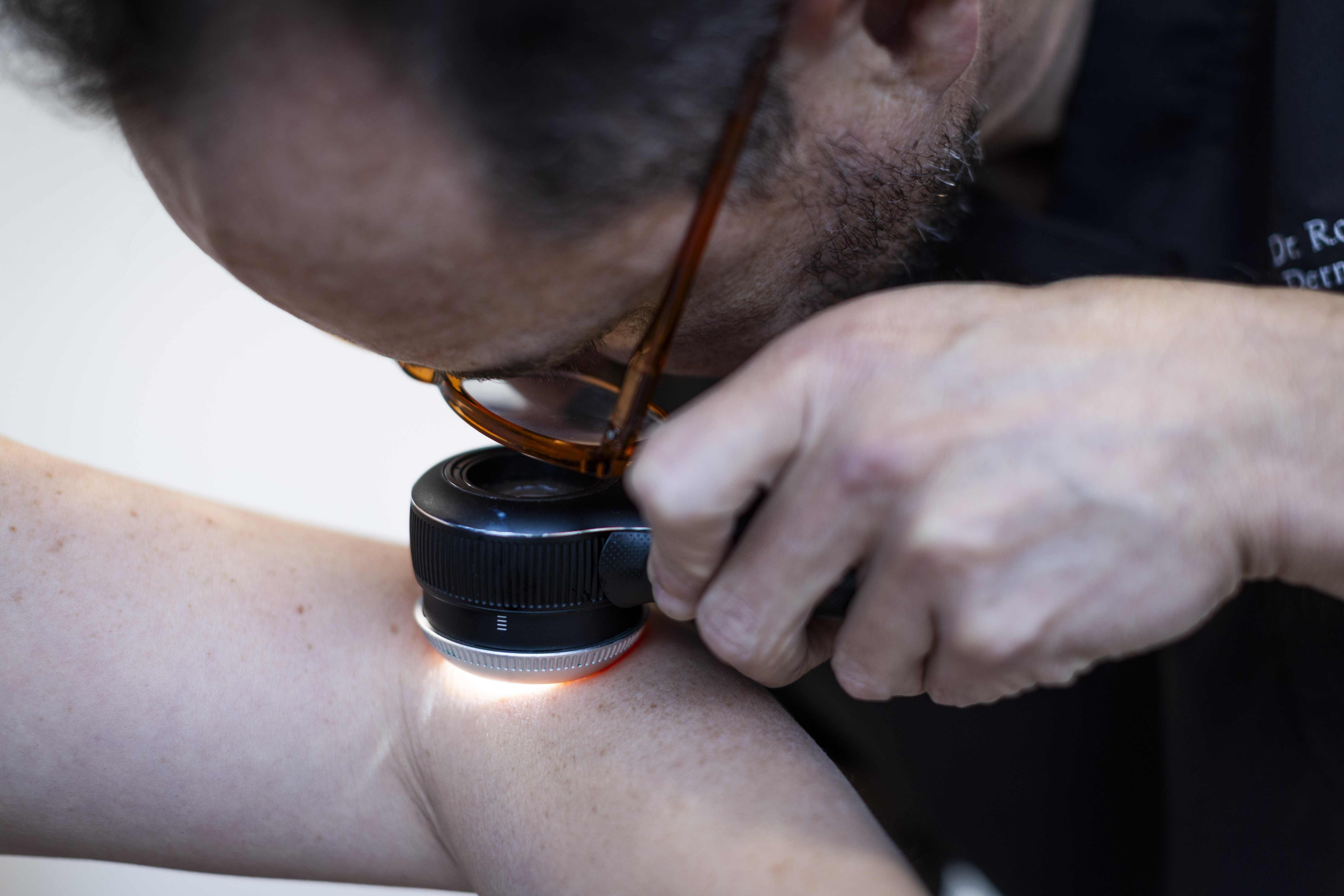 Melanoma detección temprana